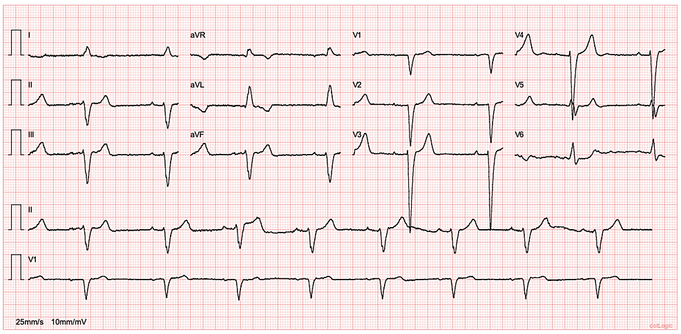 Electrocardiogram-showing-sinus-rhythm-(51/min),-first-degree-atrioventricular-block-(PR-interval-of-218ms),-and-left-bundle-branch-block.