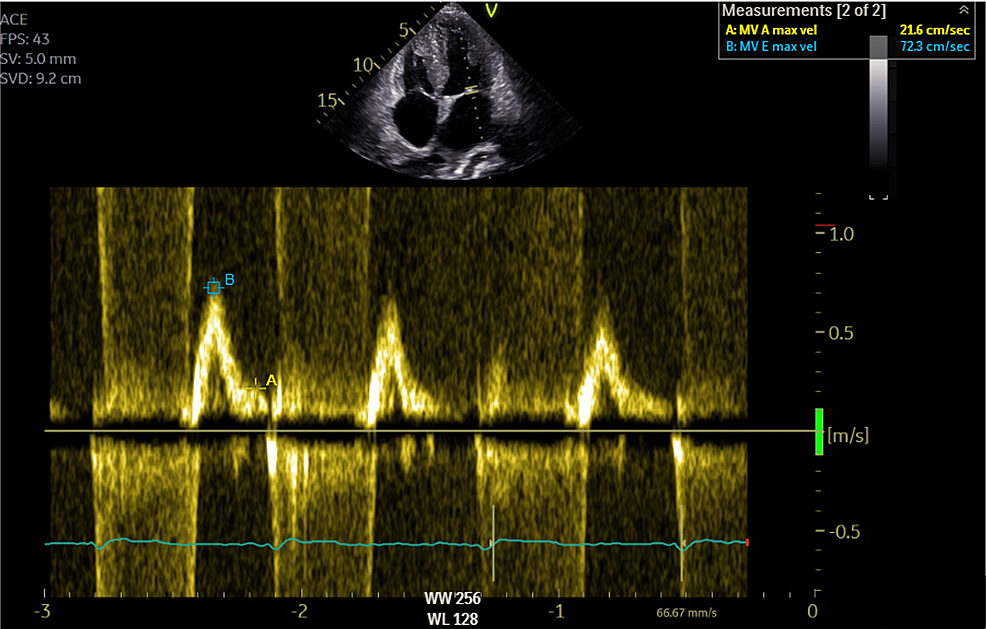 Echocardiography-showing-grade-III-diastolic-dysfunction-with-an-E/A-ratio-superior-to-2.