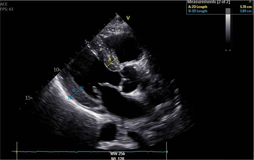 Parasternal-long-axis-view-echocardiography-revealing-severe-concentric-left-ventricular-hypertrophy-(posterior-wall-19-mm),-thickened-interventricular-septum-(interventricular-septum-17-mm),-and-atrioventricular-valves.-