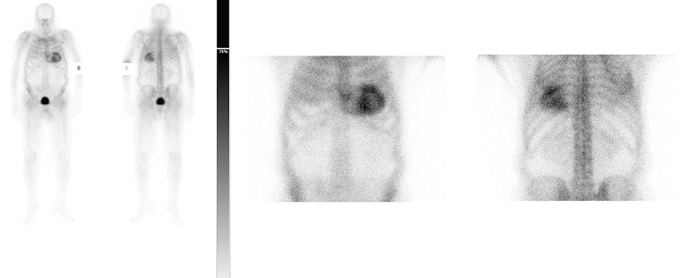 Scintigraphy-with-99m-Technetium-labeled-3,3-diphosphono-1,2-propano-dicarboxylic-acid-(DPD)-showing-myocardial-uptake-greater-than-bone-with-reduced/absent-bone-uptake-–-Perugini-grade-3.