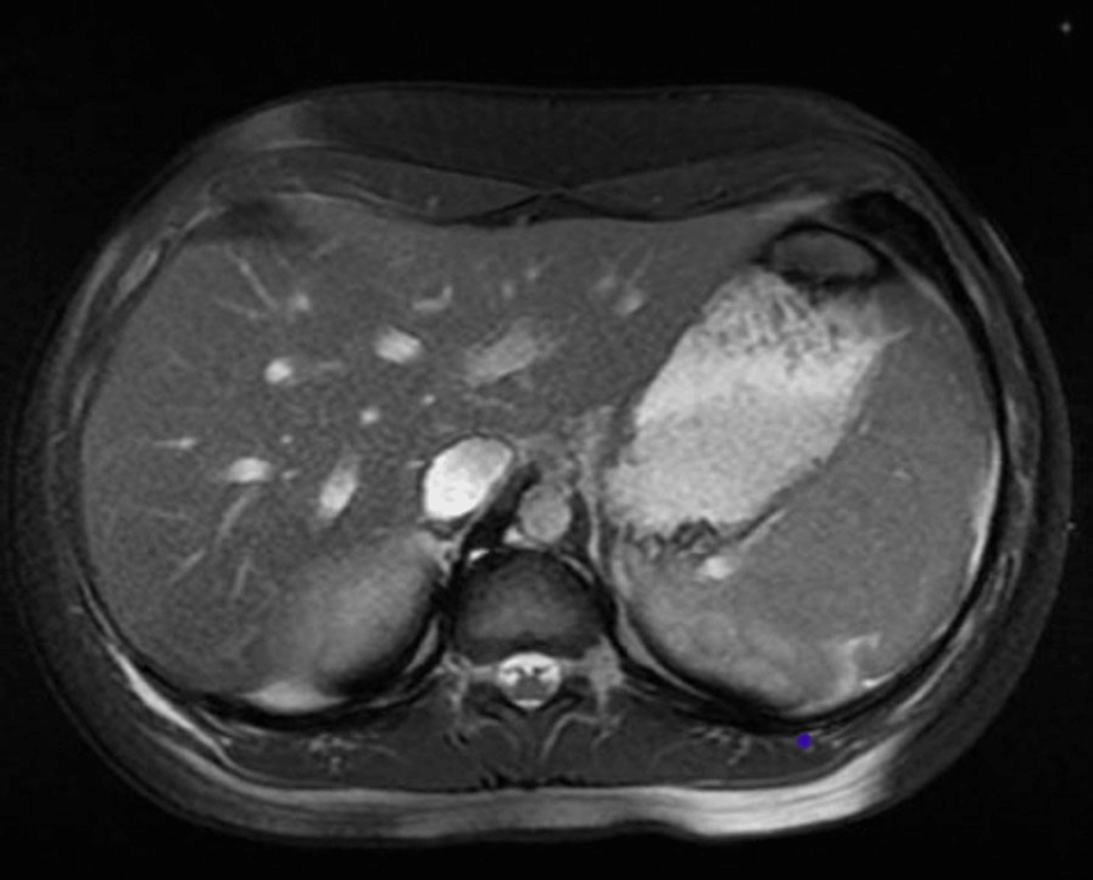 amoxicillin-clavulanate-induced-liver-injury-in-a-young-female-cureus