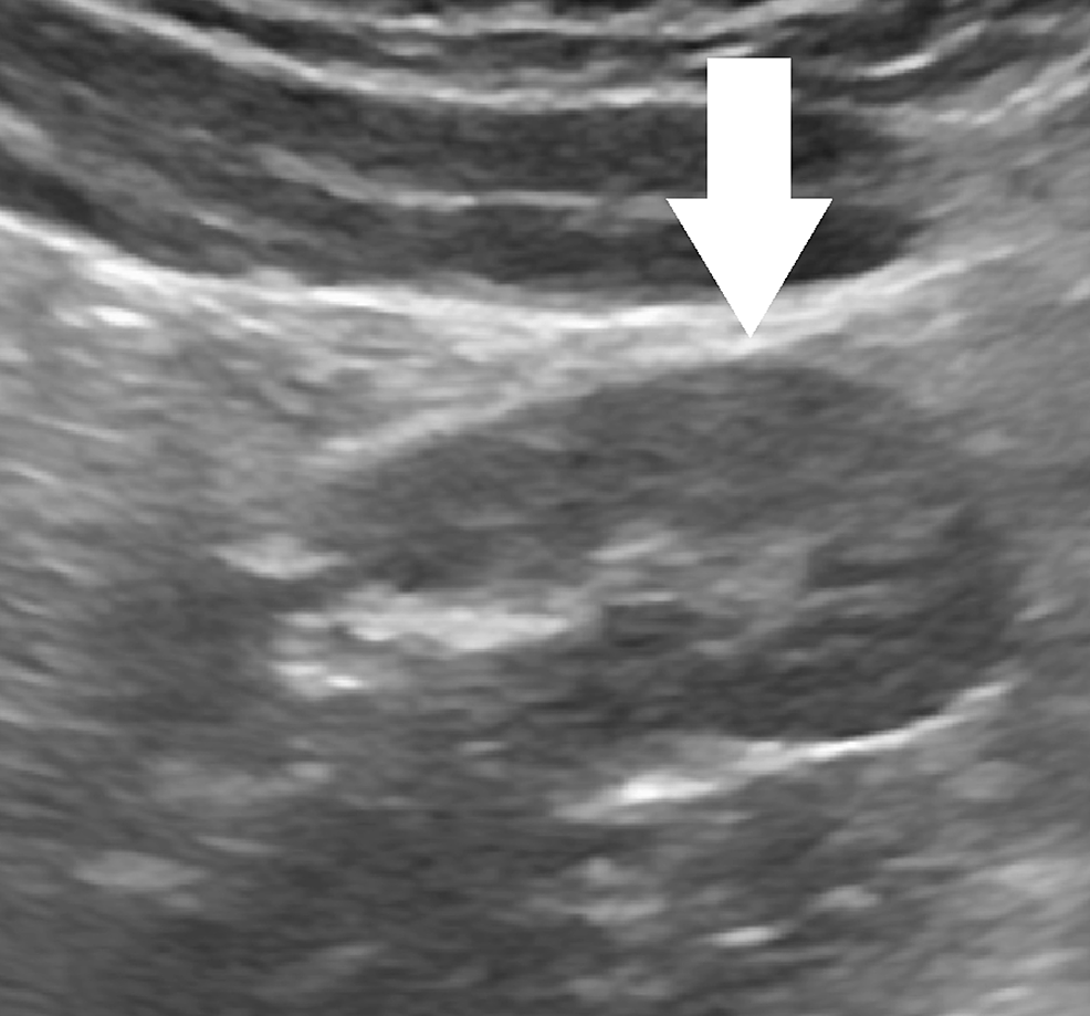 A Case of Supernumerary Kidney Cureus