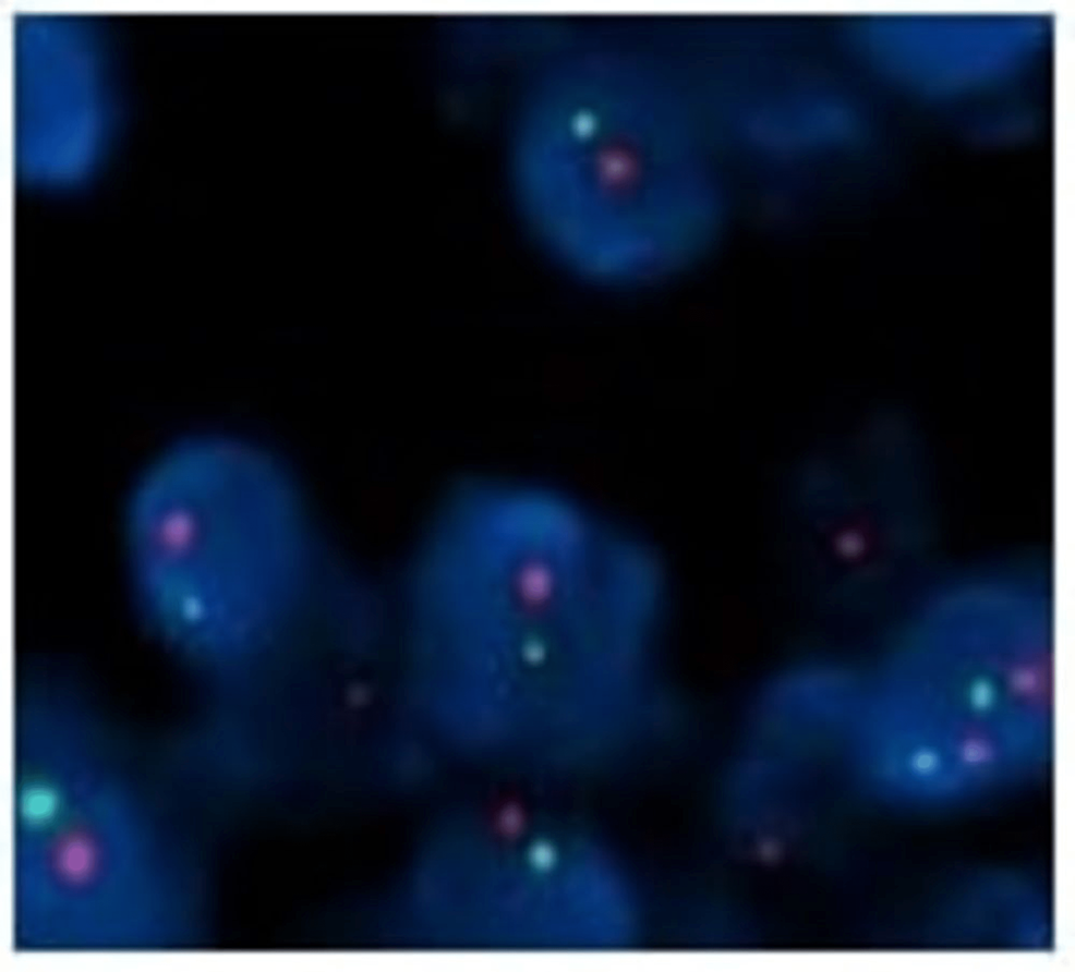 Cureus Hepatic Plasmacytoma With DEL13q14 Positive on Fluorescent In