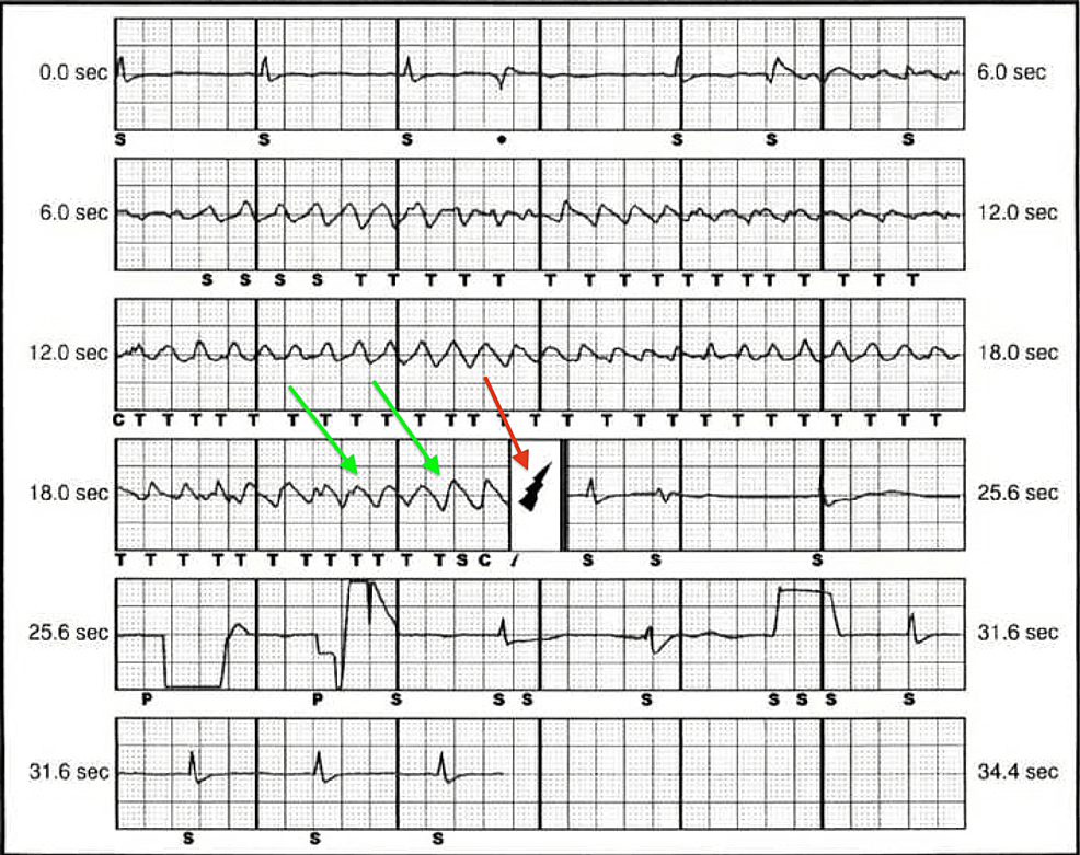 Cureus A Coronary Cameral Fistula Associated With Incessant