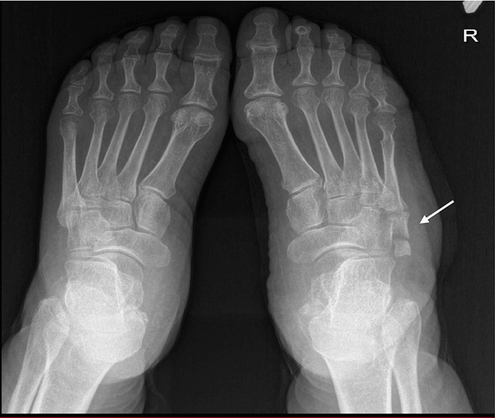 Cureus Iselin Disease With a Rare Presentation in an Elderly Patient A Case Report