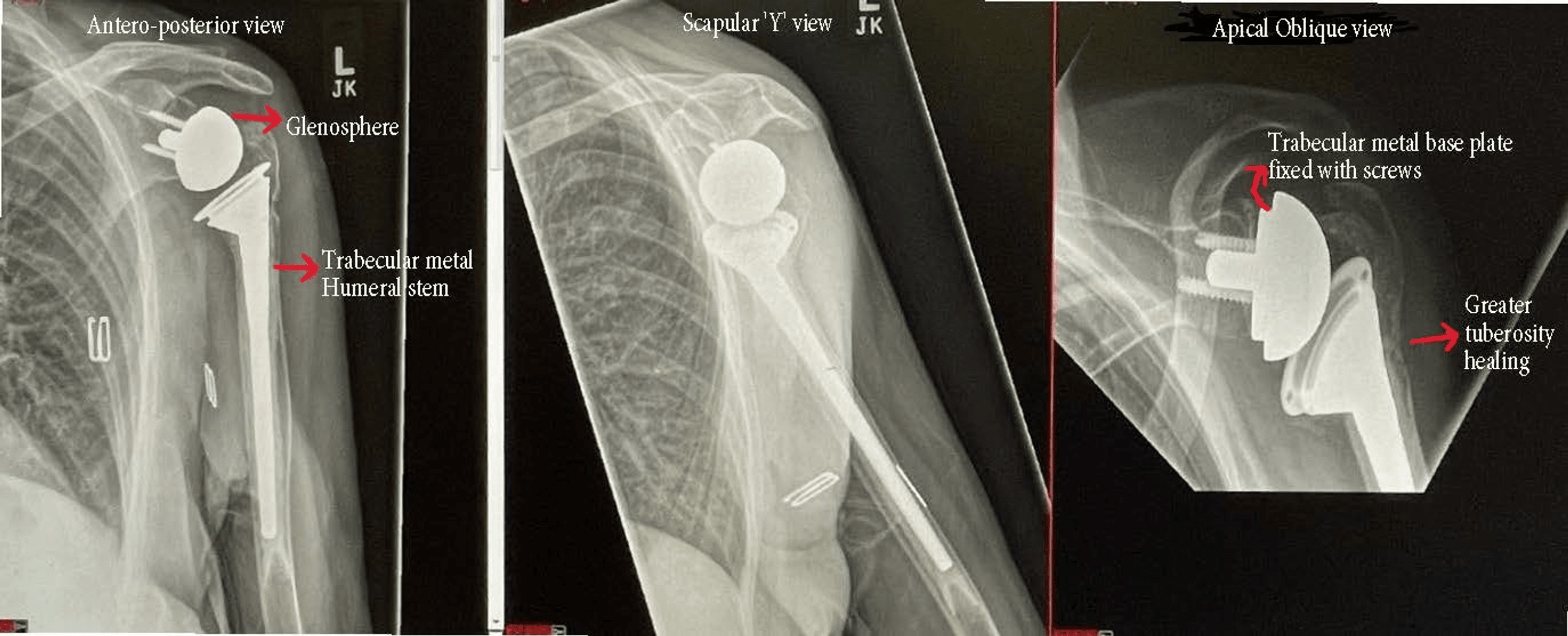 Cureus Reverse Shoulder Arthroplasty for Acute Proximal Humerus