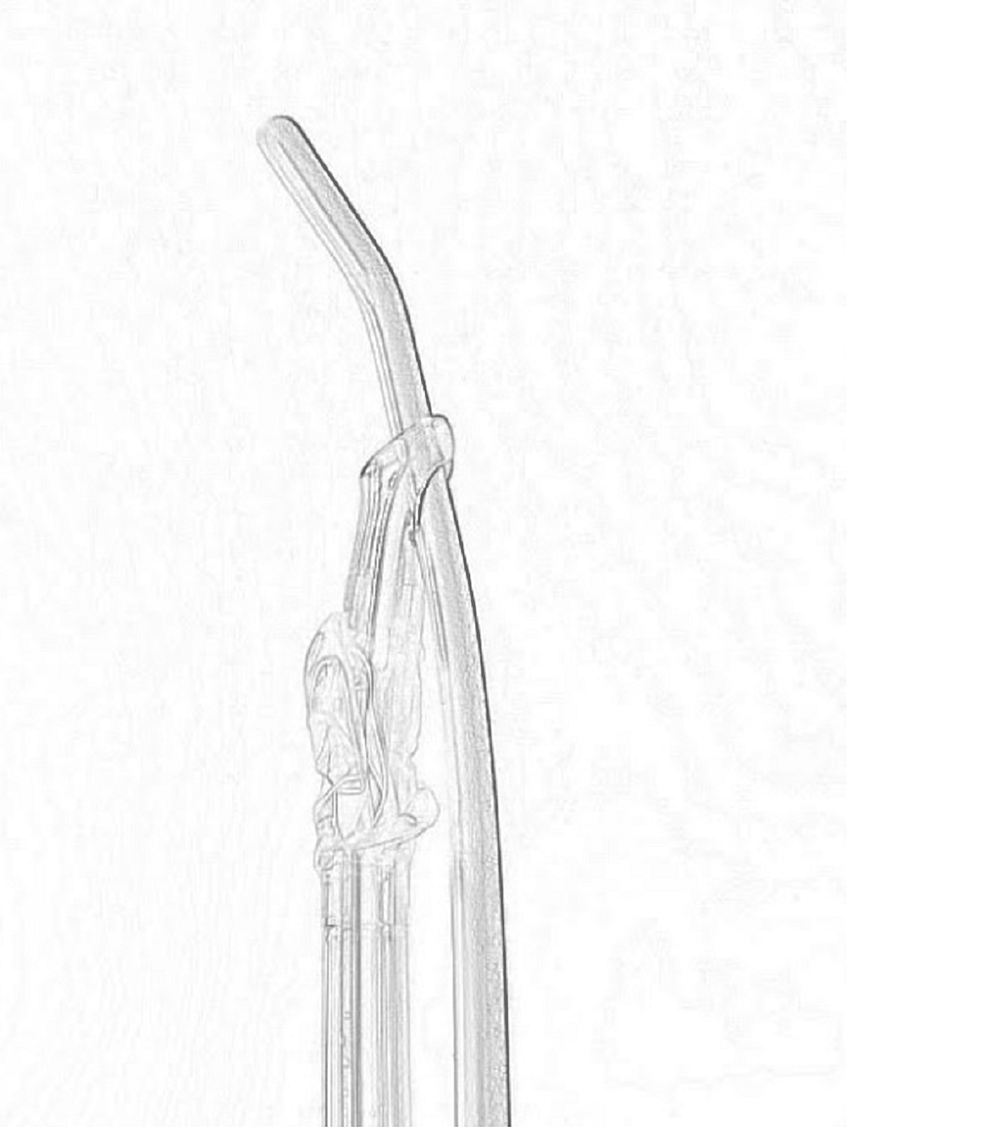 Advancement-of-the-first-endotracheal-tube-through-the-bougie-using-the-Murphy-eye