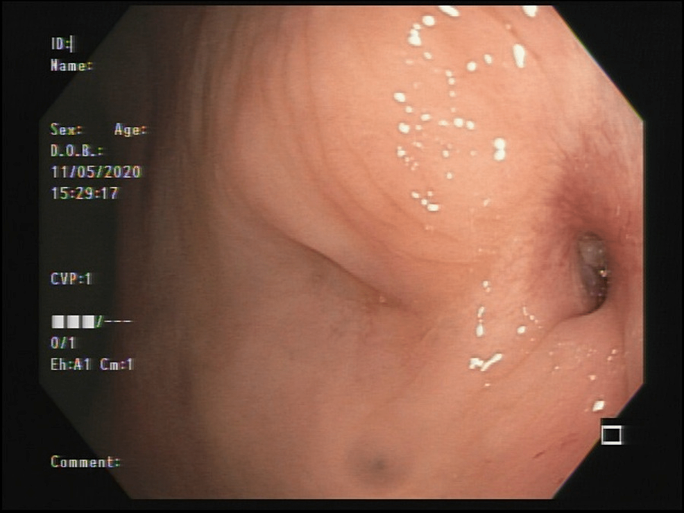 PADLOCK CLIP™ Defect Closure System - Closure of colonoscopy