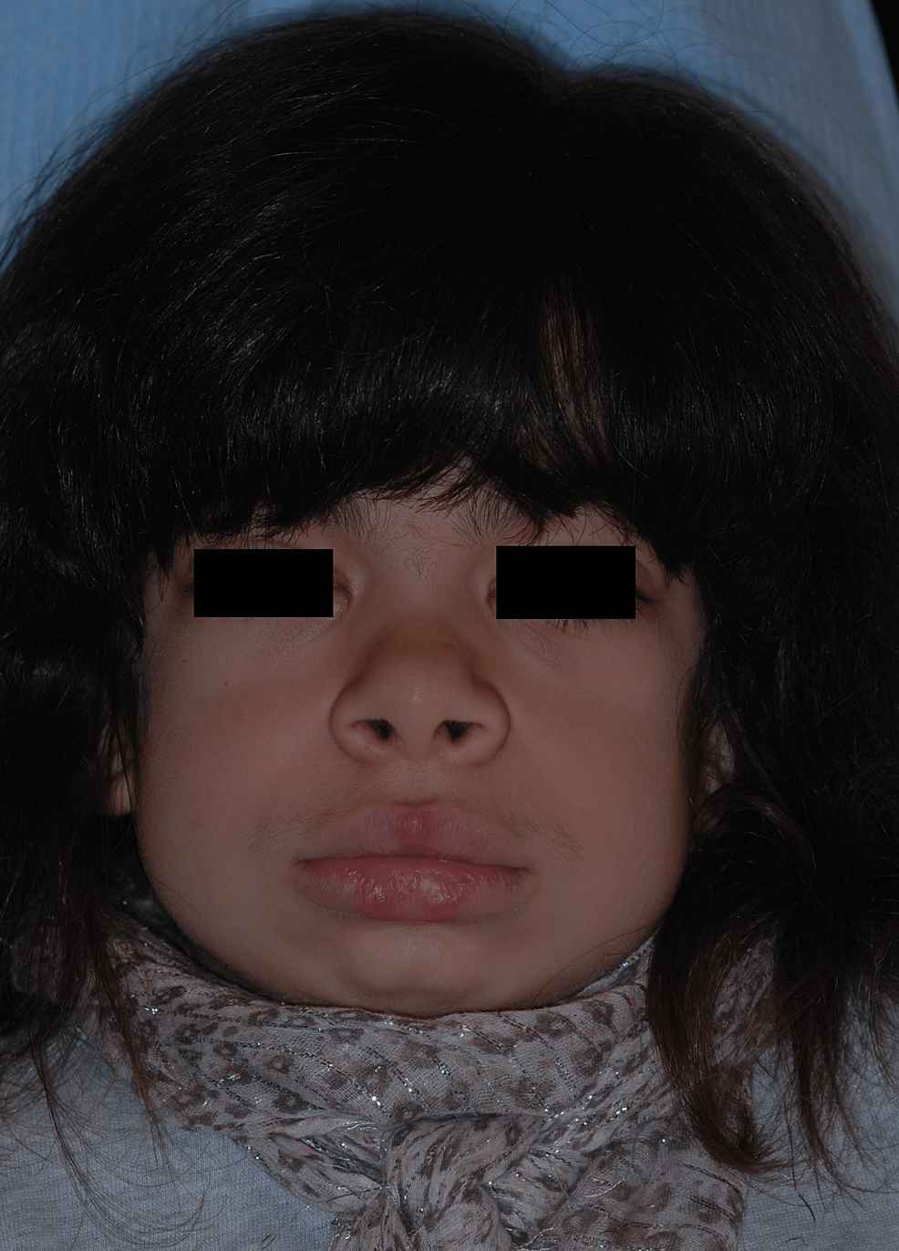 hurler syndrome corneal clouding