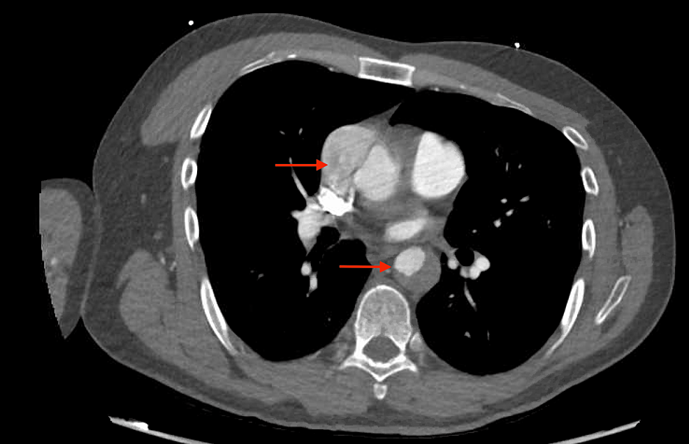 Cureus | Sudden-Onset Paraplegia: A Unique Presentation Of Acute Aortic ...