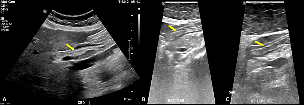 Ultrasound-of-abdomen-showing-a-linear-echogenic-structure-in-the-A)-CBD,-B)-epigastric-region-and-C)-right-lumbar-area-(yellow-arrows).-