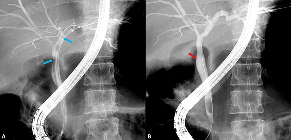 Cholangiogram-showing-A)-a-big-adult-worm-in-the-left-hepatic-duct-and-proximal-CBD-(blue-arrows)-and-B)-absent-adult-worm-after-removal-using-guidewire-(red-arrow).