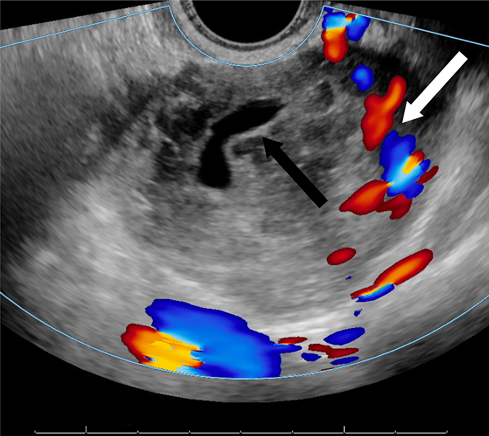 ruptured ectopic pregnancy ultrasound