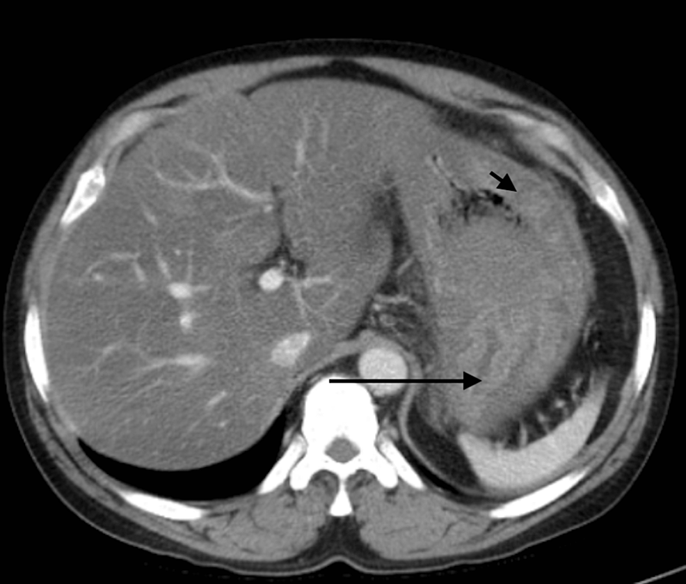 A Rare Case of Phlegmonous Gastritis in a Previously Healthy Male A