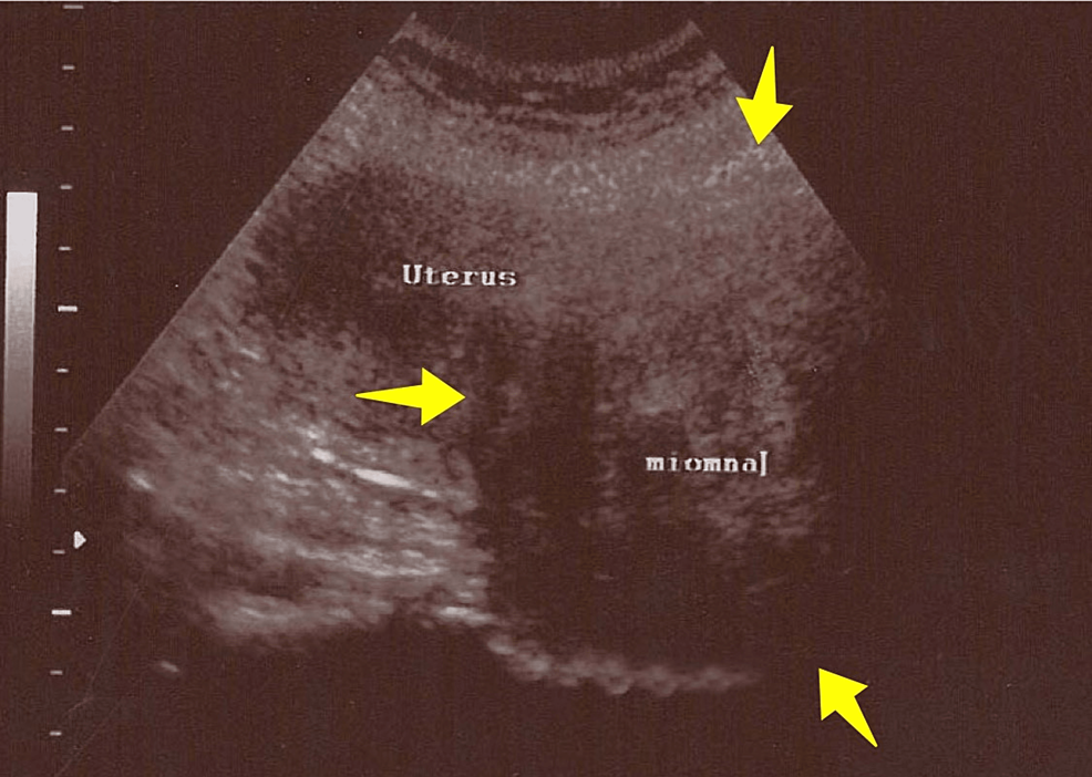 PDF] Uterine prolapse as an unusual cause of obstructed labor: A case  report