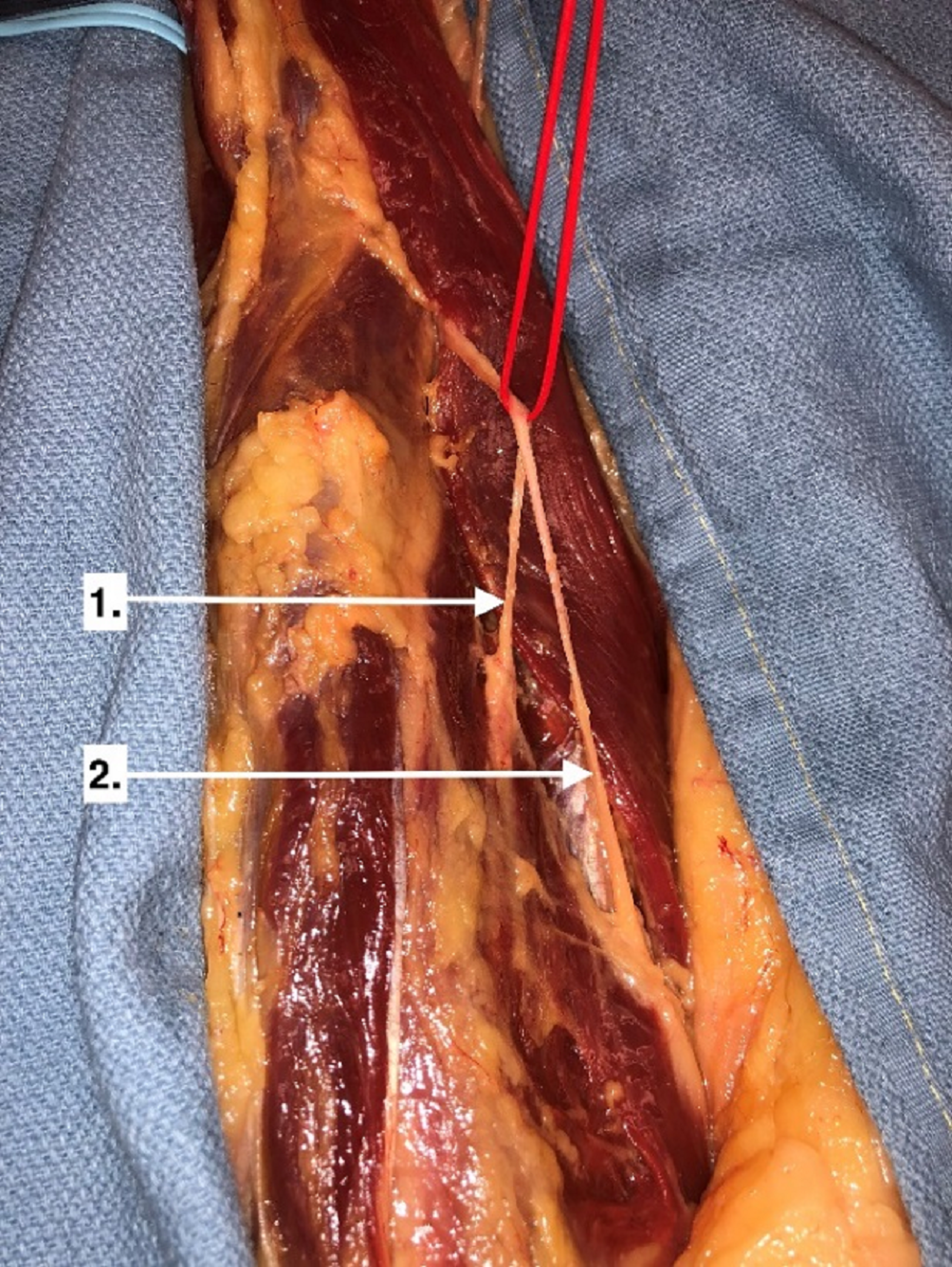 Cureus | The Relative Location of the Major Femoral Nerve Motor