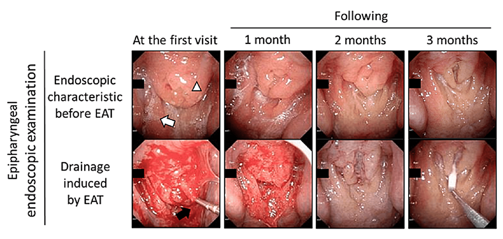 Cureus  A Potential Novel Treatment for Chronic Cough in Long