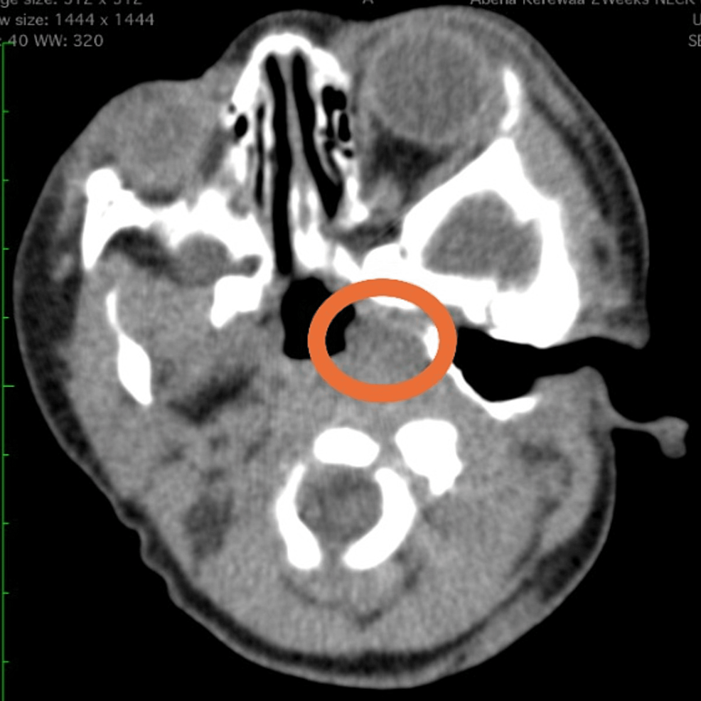 Cureus Congenital Laryngeal Hemangioma A Case Report of a Rare