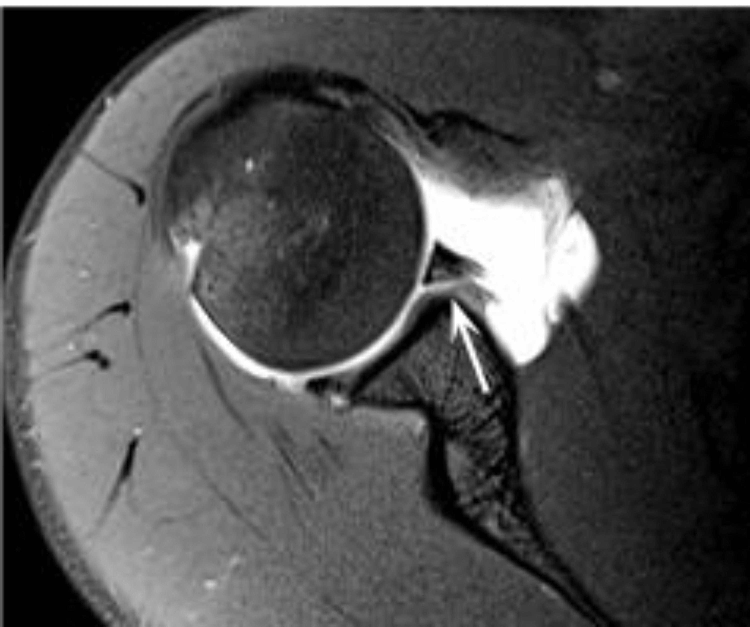 Type IX Superior Labrum Anterior and Posterior Lesion in a Professional