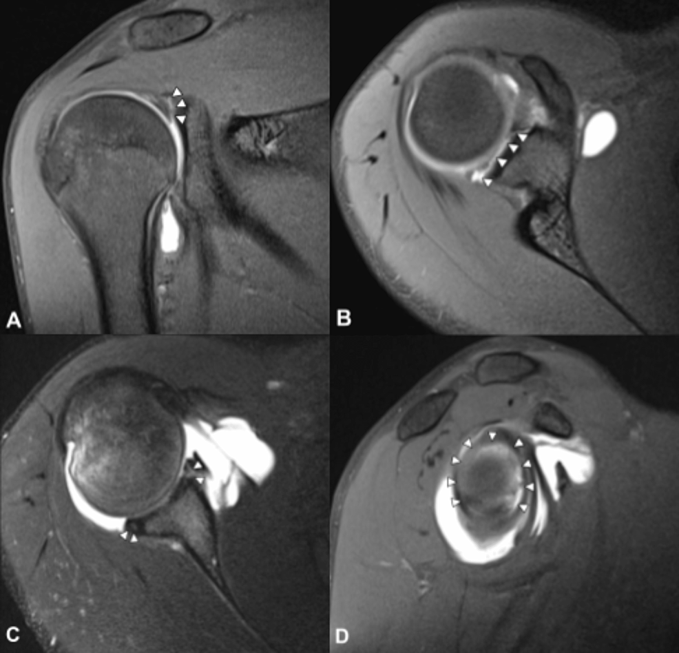 Type IX Superior Labrum Anterior and Posterior Lesion in a Professional