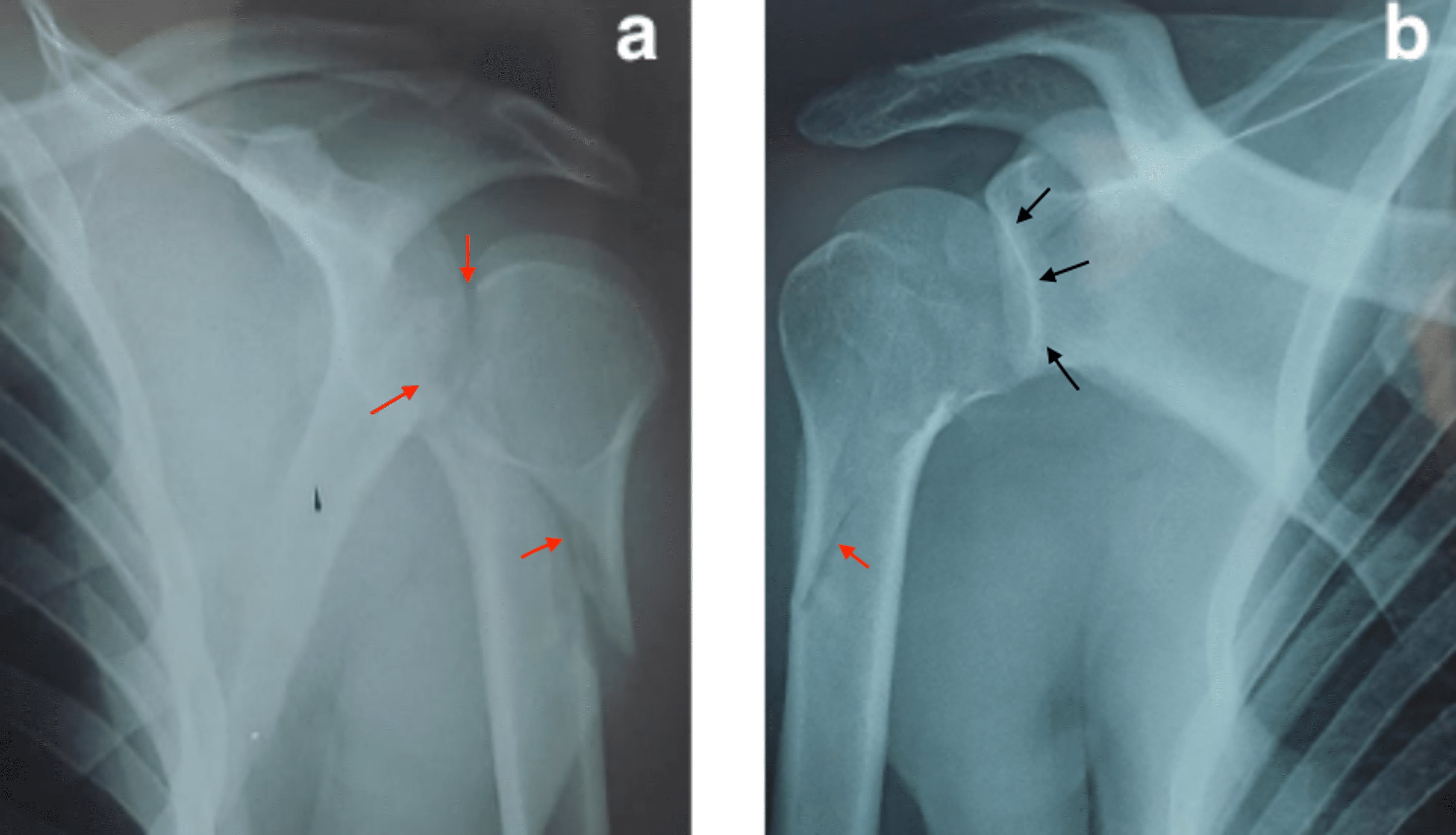 Irreducible Posterior Fracture Dislocation Of The Shoulder A Case