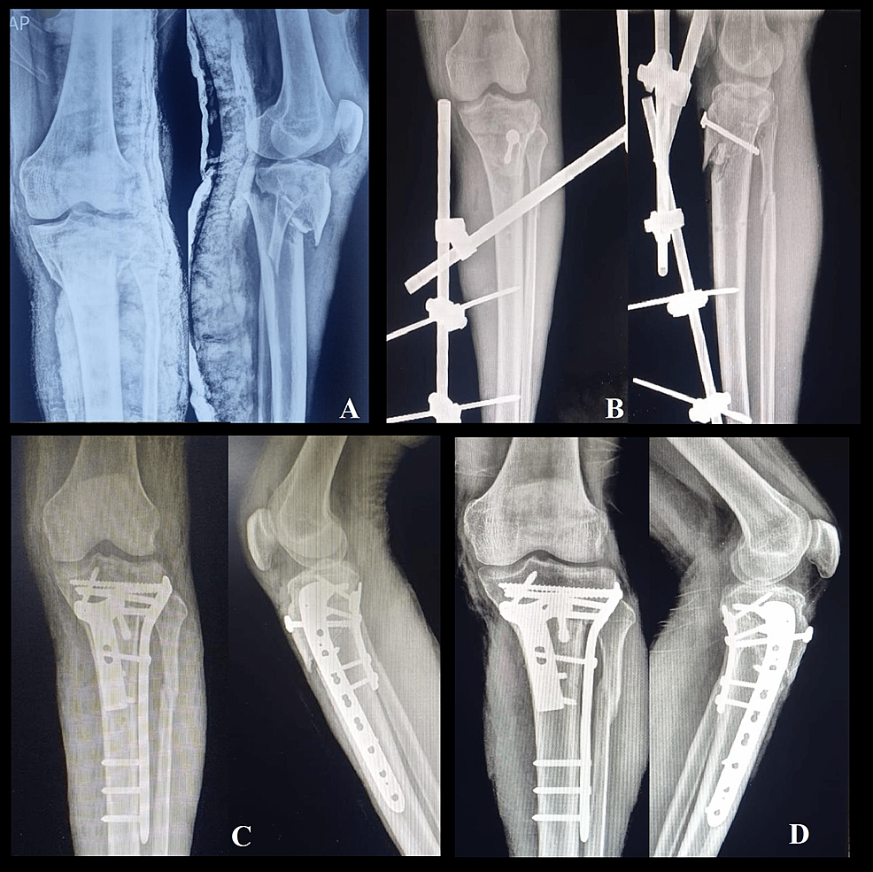 Cureus | Supplementary Posteromedial Plating For The Fixation Of ...