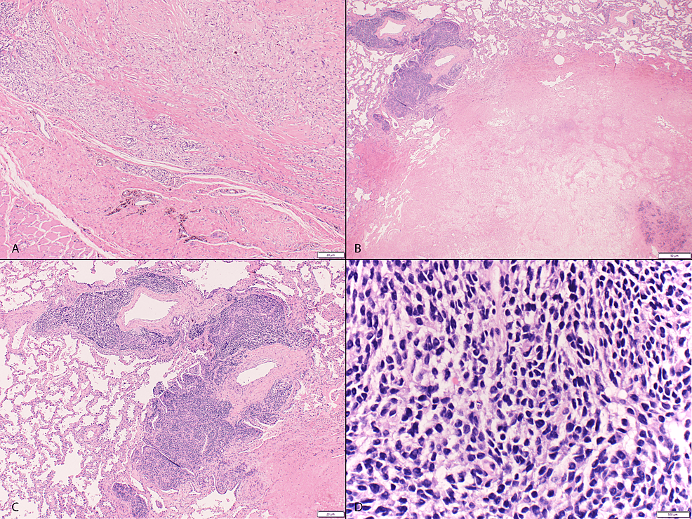 cureus-patched-homolog-1-ptch1-mutation-in-a-cic-rearranged-sarcoma