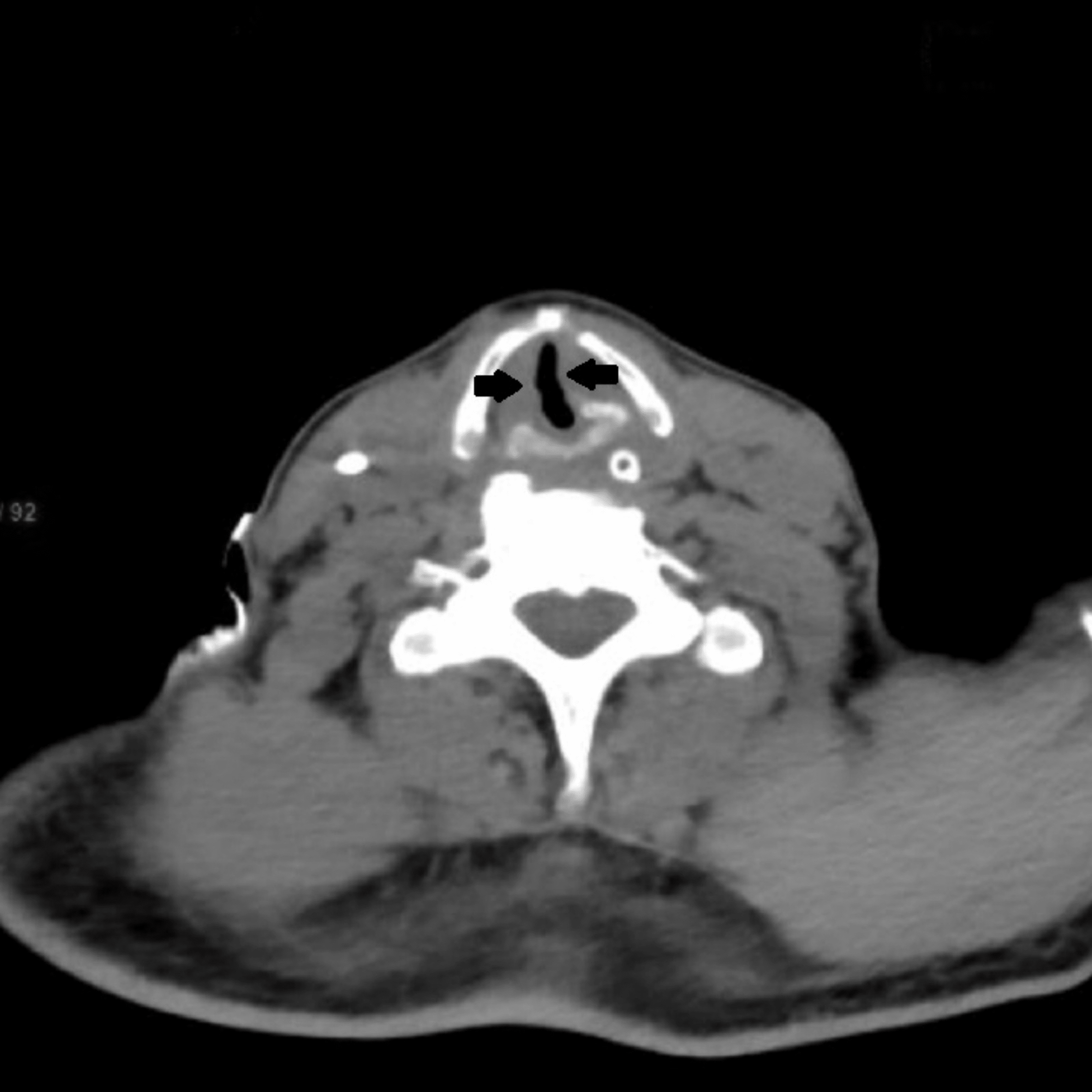 Postextubation Stridor in a Case of Intracranial Bleed Assessing