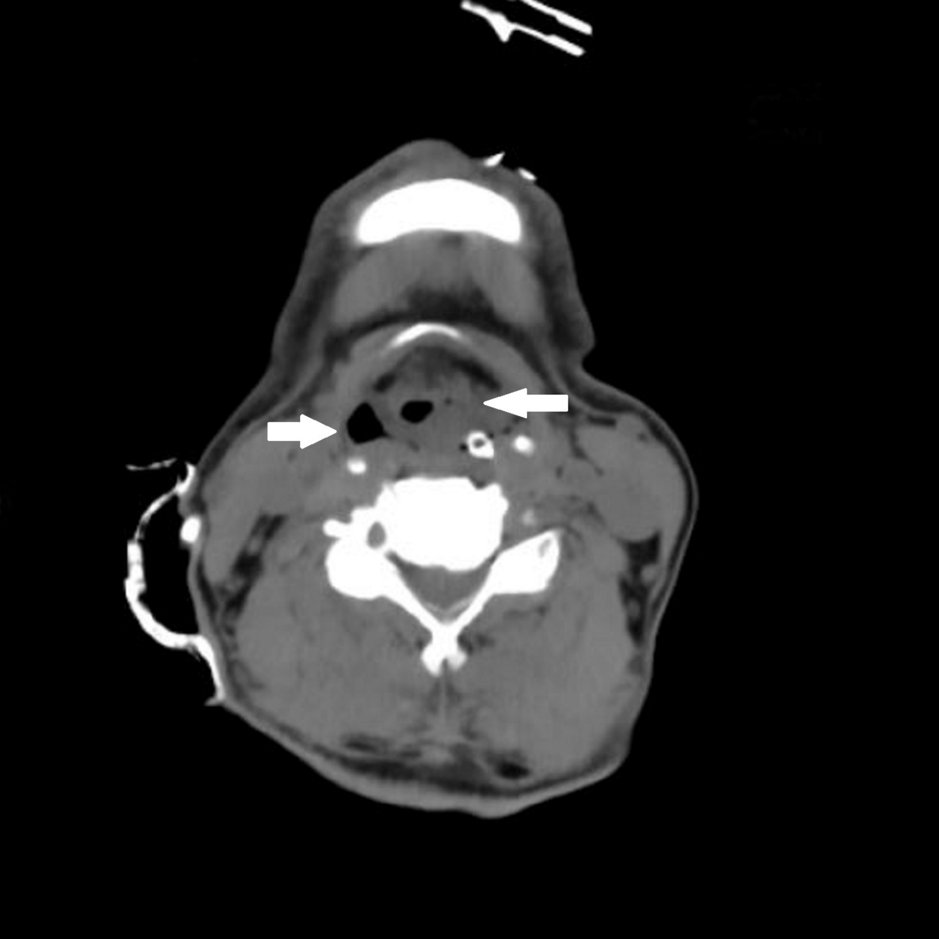 Postextubation Stridor in a Case of Intracranial Bleed Assessing