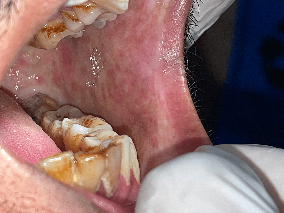 Assessment of Oral Lesions With Tobacco Usage A CrossSectional Clinicopathological Study in