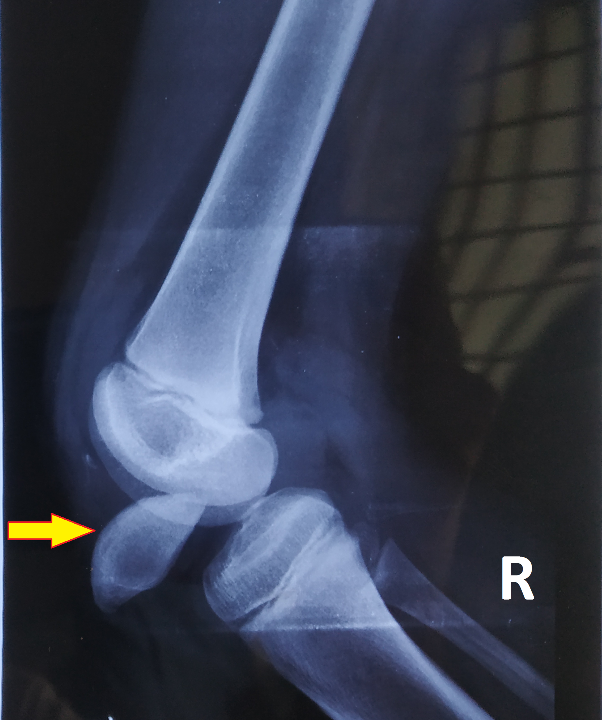 Cureus | Traumatic Intra-articular Intercondylar Dislocation Of The ...