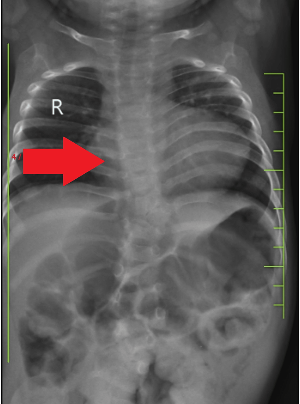 Cureus | An Incidental Finding of Butterfly Vertebrae in a Case of