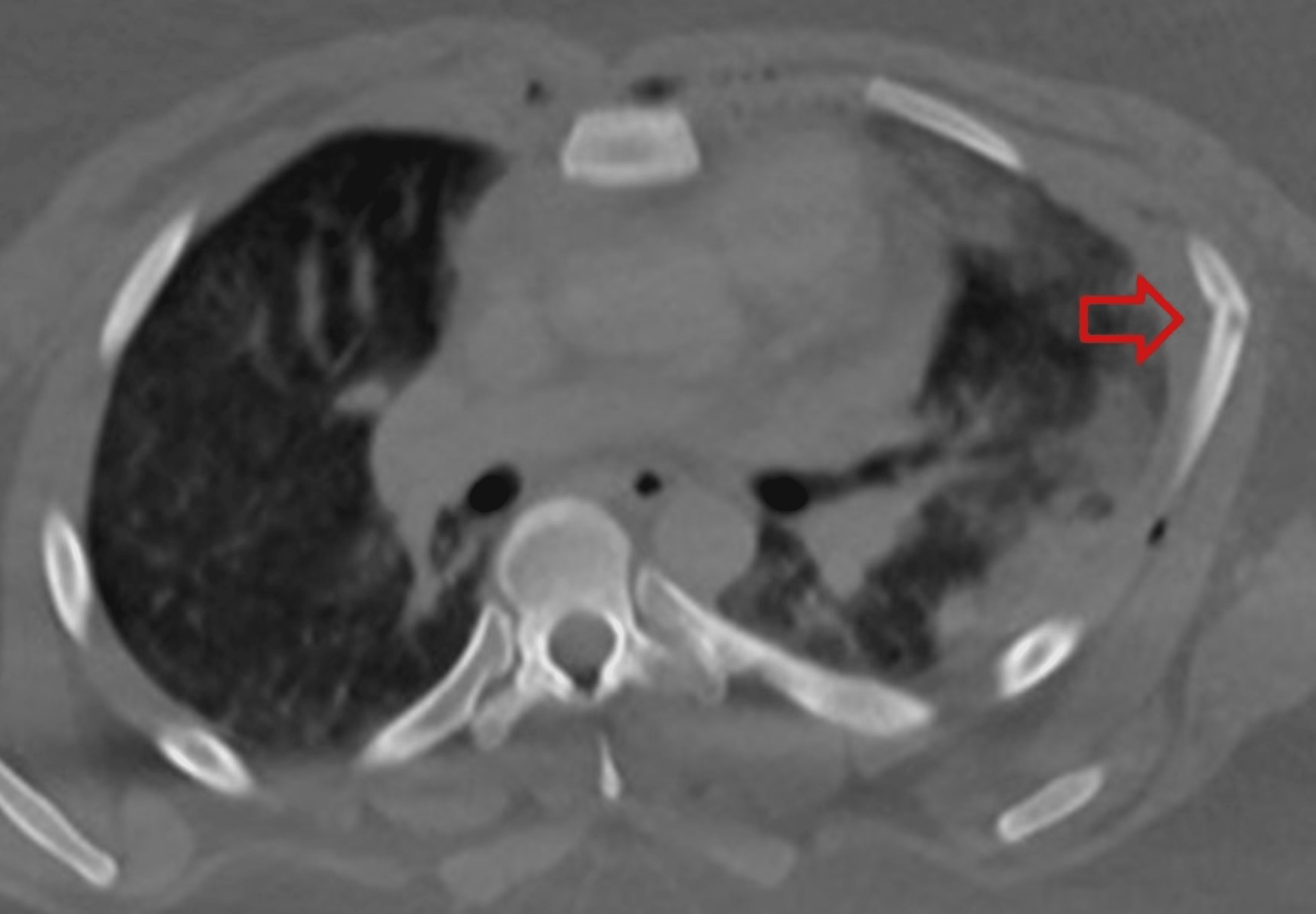 Cureus A Novel Approach to Sternal Fracture Repair With the Implementation of a Compression