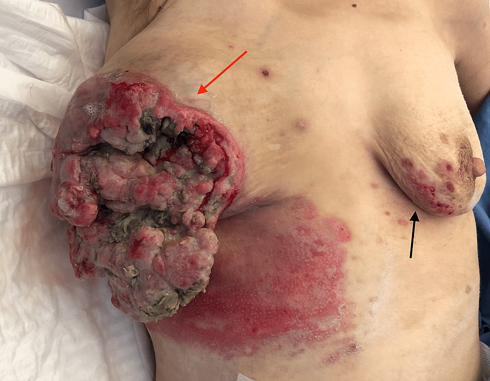 PDF) Necrotizing Cutaneous Fungal Infection of the Breast in a