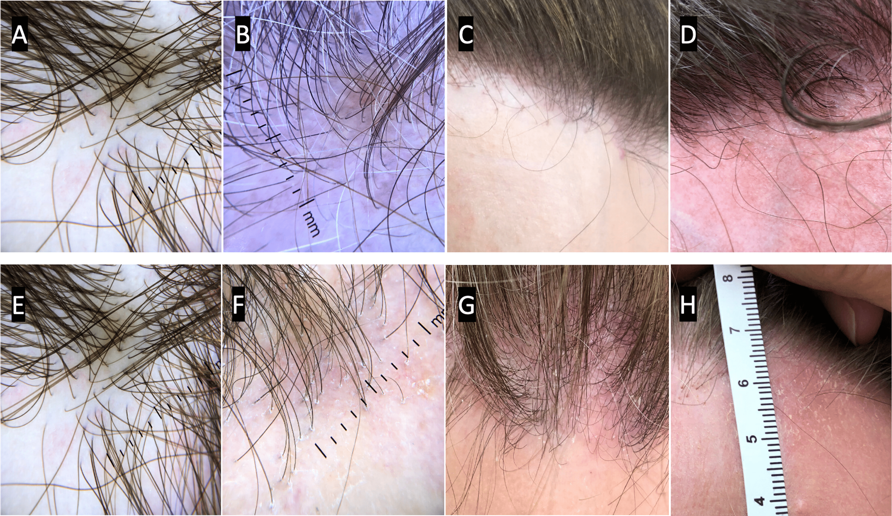 Cureus | Oral Low-Dose Naltrexone in the Treatment of Frontal Fibrosing  Alopecia and Lichen Planopilaris: An Uncontrolled Open-Label Prospective  Study | Article