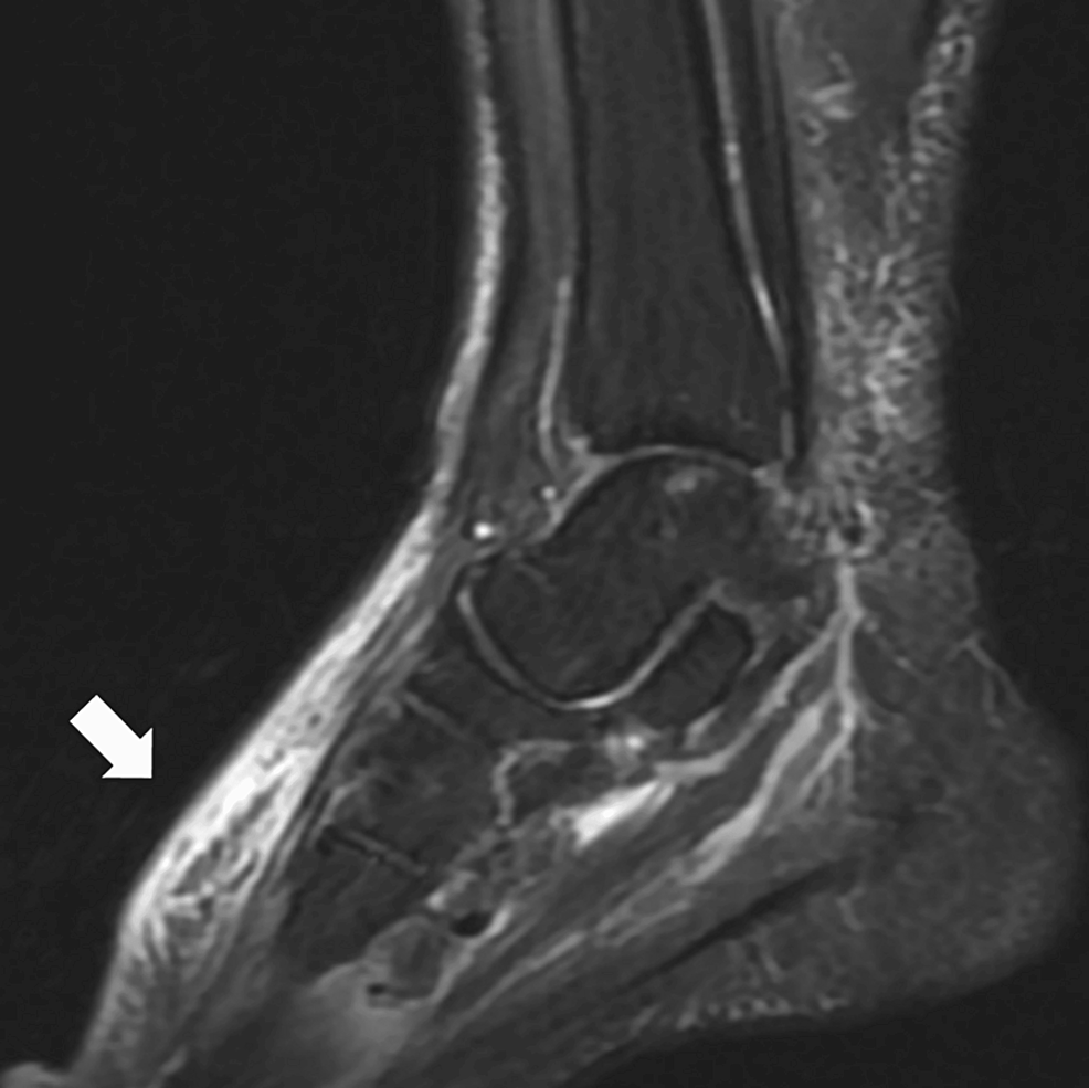 Subacute Bacterial Cellulitis With a Subacute Clinical Course With ...