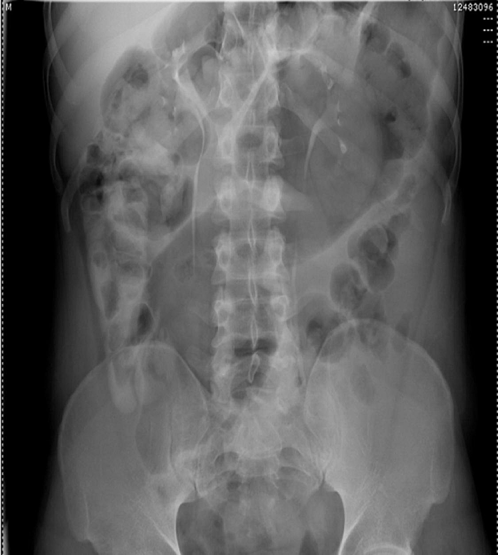 Imaging, Endoscopic and Genetic Assessment of Marfan Syndrome ...