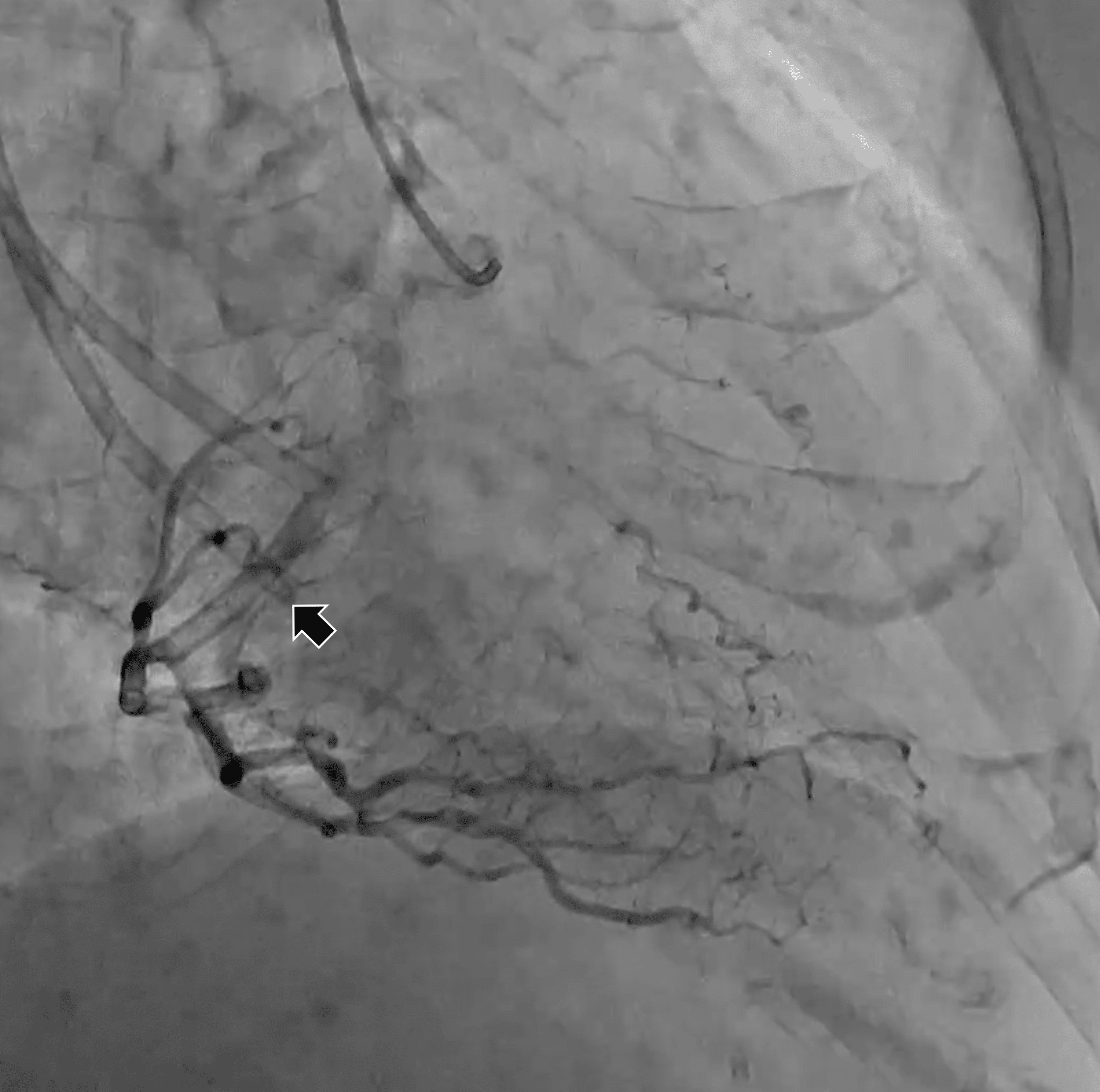 Cureus Endovascular Retrieval of a Fractured Tunneled Hemodialysis