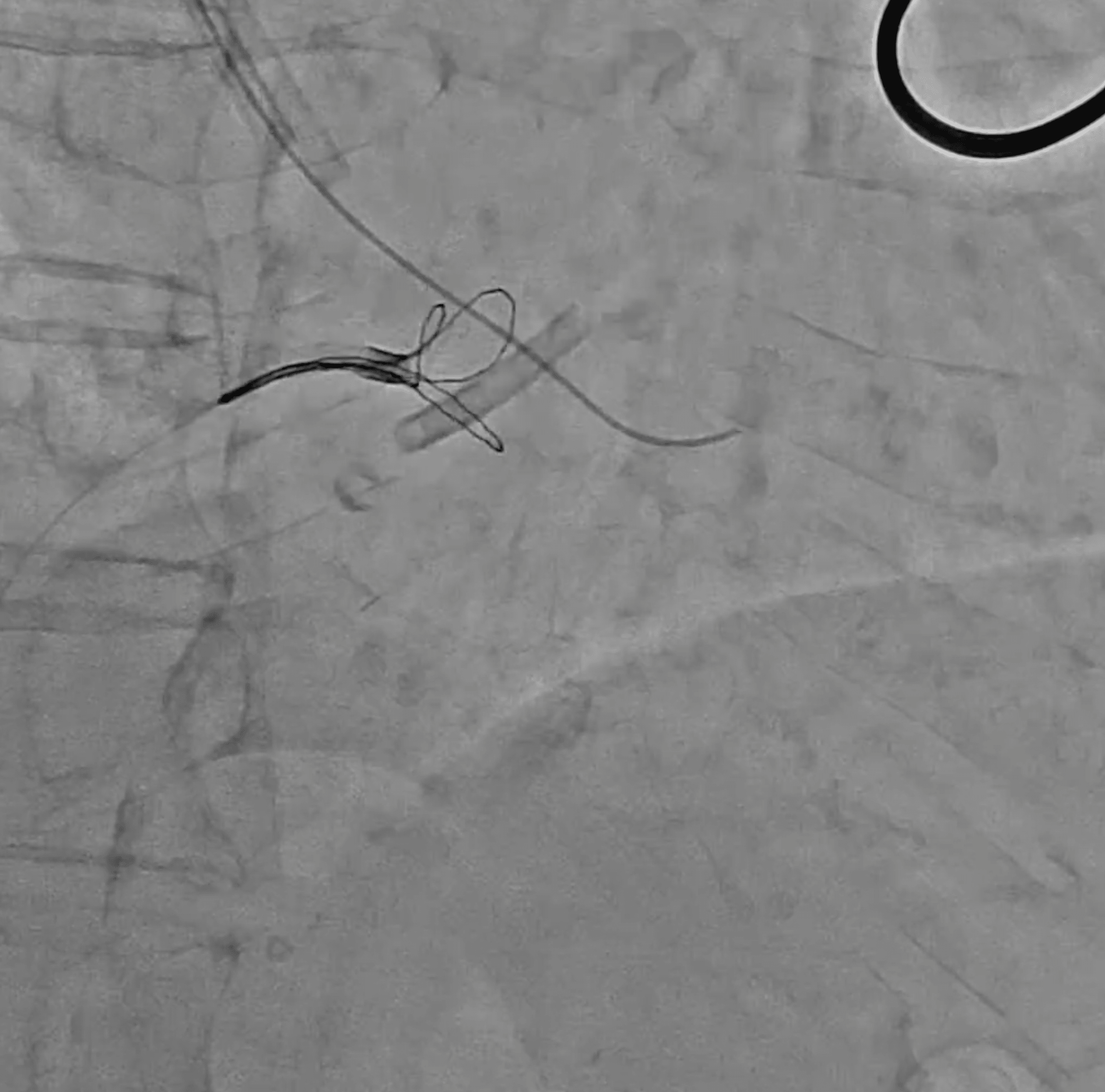 Endovascular Retrieval Of A Fractured Tunneled Hemodialysis Central ...