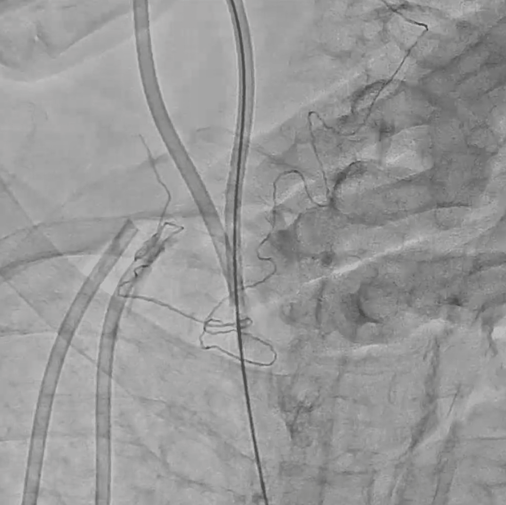 Cureus Endovascular Retrieval of a Fractured Tunneled Hemodialysis