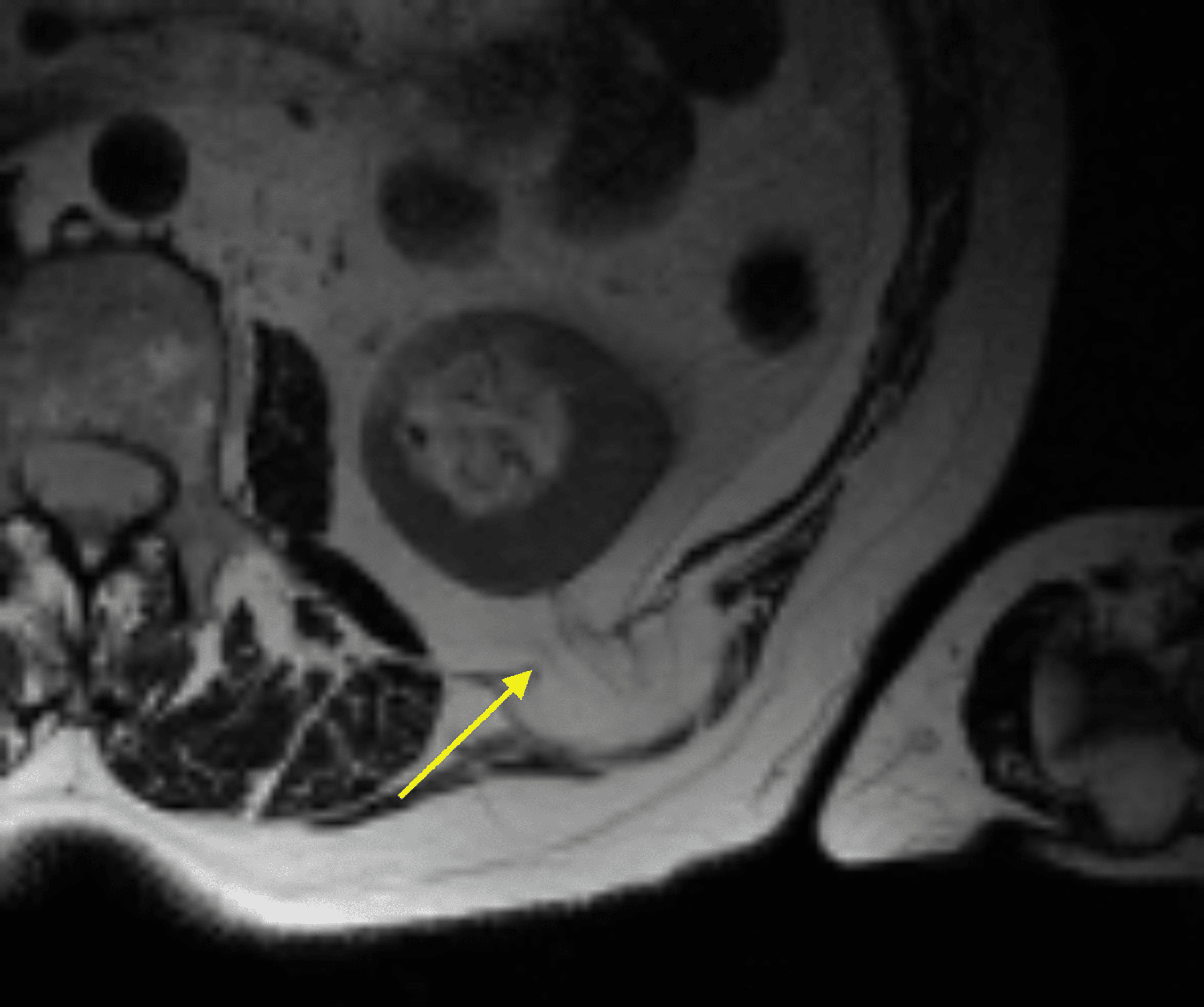 Cureus A Case of an Atraumatic Posterior Perirenal Lumbar Hernia