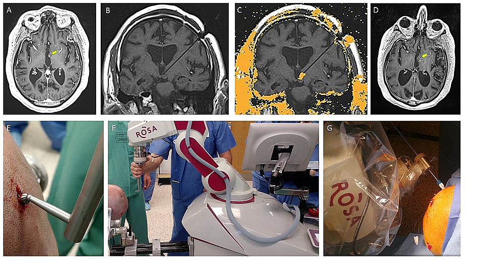 Cureus Robot Assisted Stereotactic Laser Ablation for a Radiosurgery