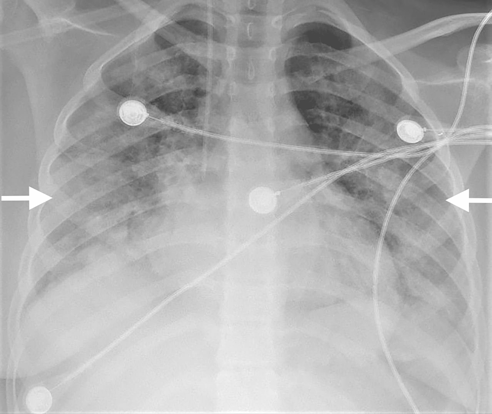 A rare case of systemic lupus erythematosus with diffuse alveolar hemorrhage and Guillain-Barre syndrome.