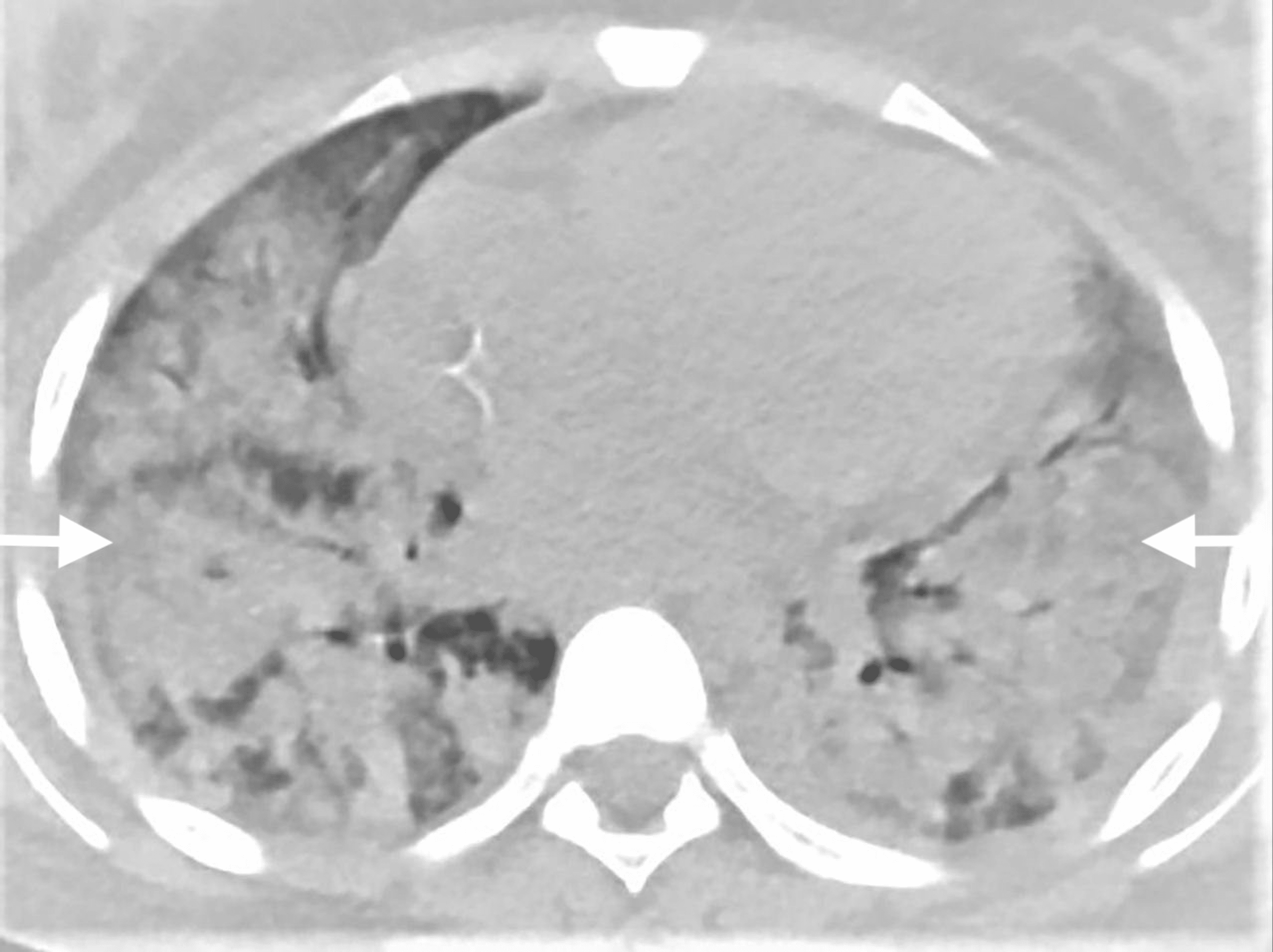 A Rare Case Of Systemic Lupus Erythematosus With Diffuse Alveolar