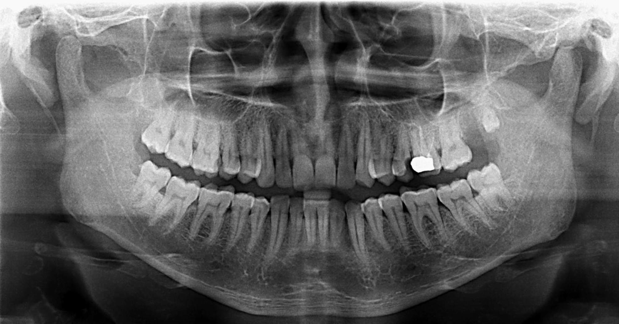 Cureus | Tooth and Advanced Oral Submucous Fibrosis Obscuring Buccal ...