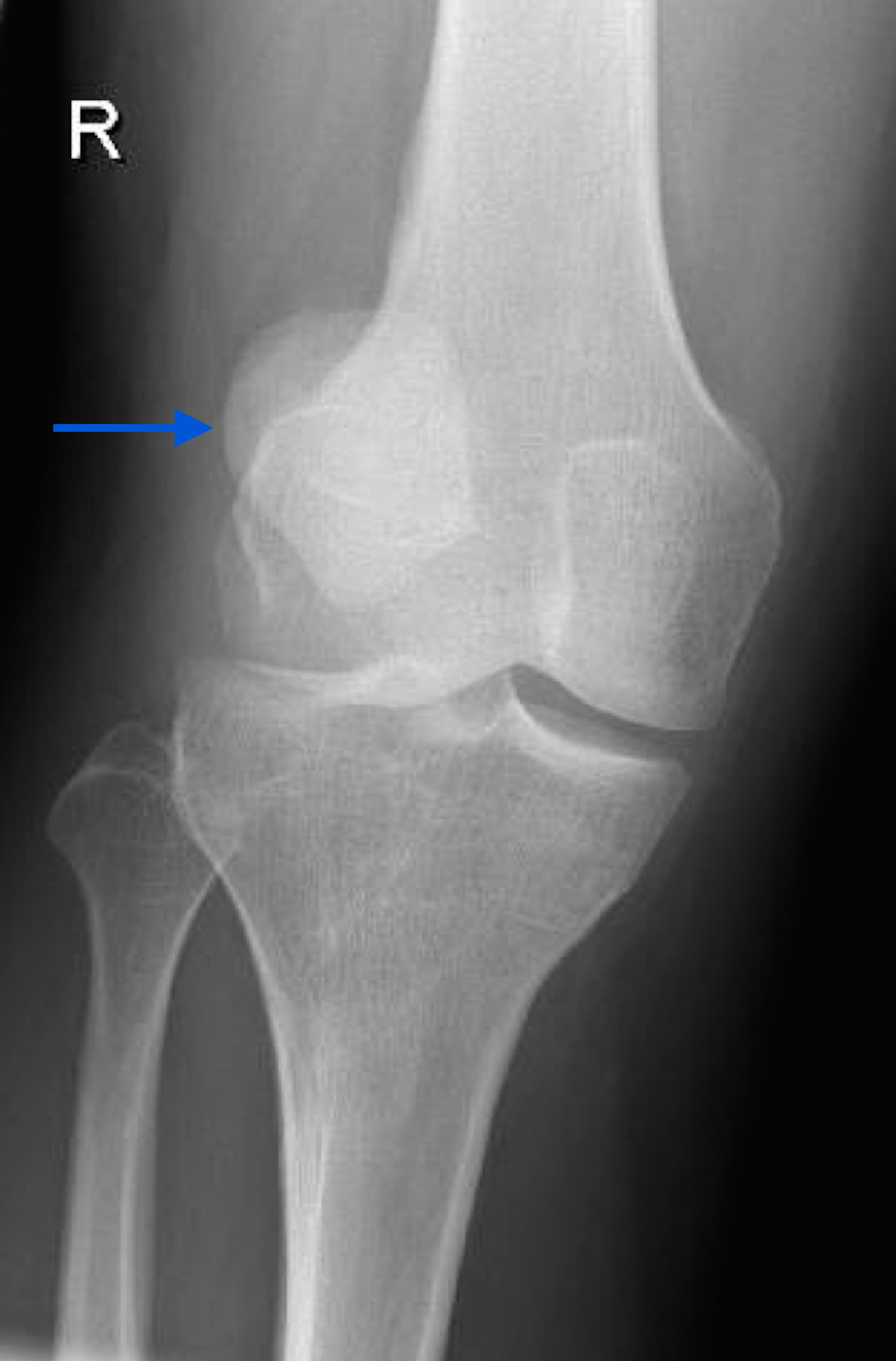 x ray of dislocated knee