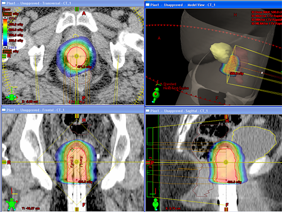 Cureus Stereotactic Body Radiosurgery Using Volumetric Arc Therapy as