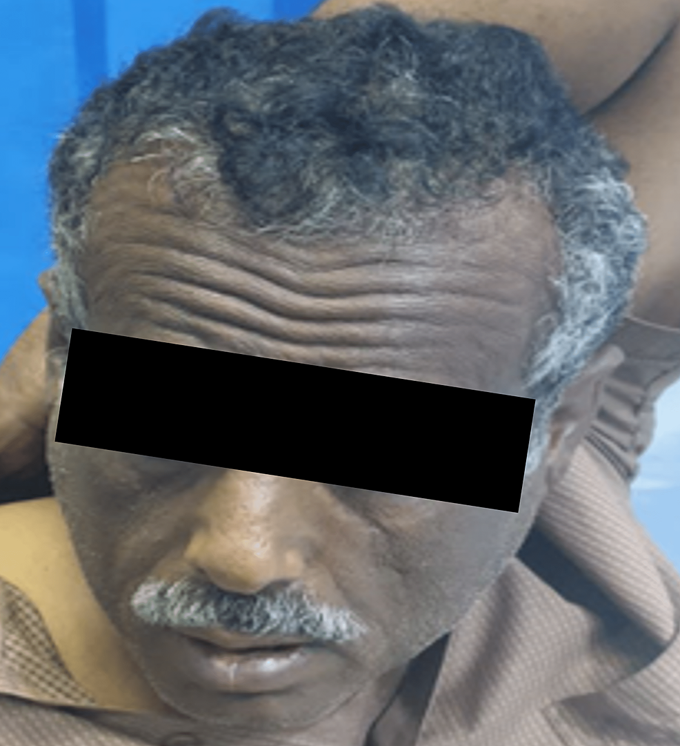 cureus-a-rare-case-of-captopril-induced-parotid-gland-enlargement