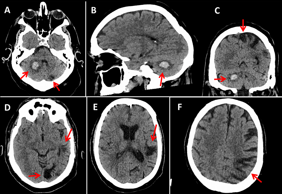 Hereditary Protein S Deficiency and Activated Protein C Resistance