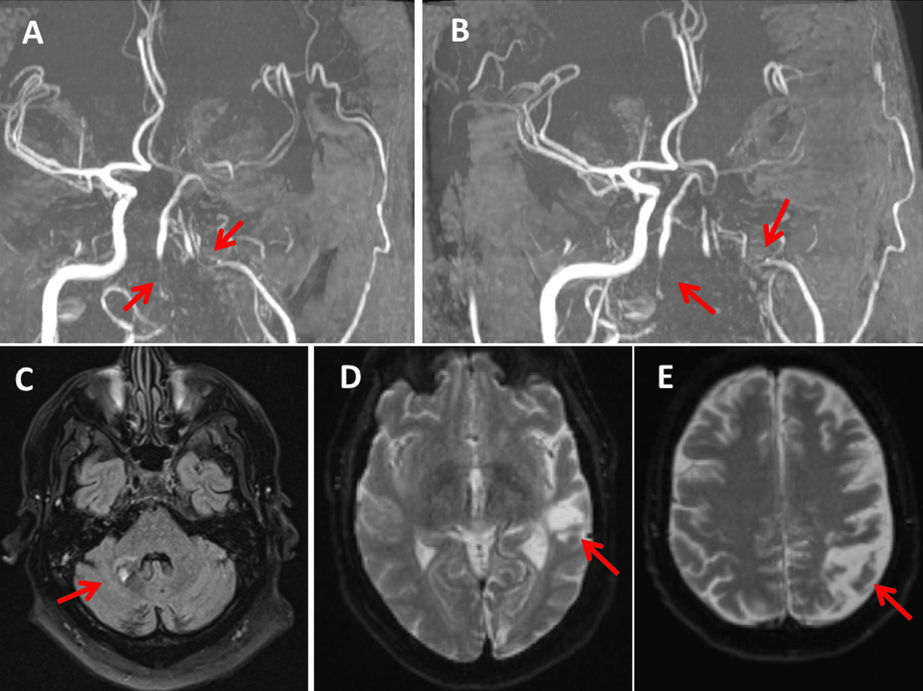 Hereditary Protein S Deficiency and Activated Protein C Resistance